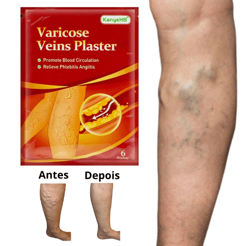 Varicose Veins Plaster - Adesivo Anti-Varizes - Facilita Shopping