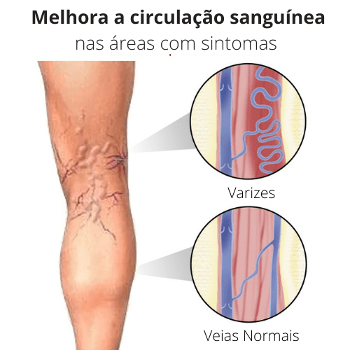 Varicose Veins Plaster - Adesivo Anti-Varizes - Facilita Shopping