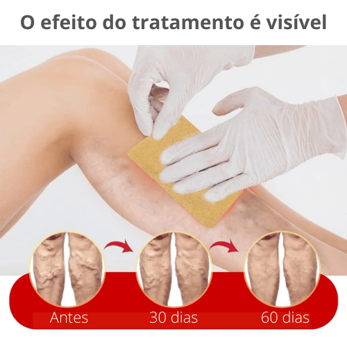 Varicose Veins Plaster - Adesivo Anti-Varizes - Facilita Shopping